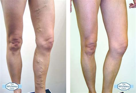 Identifying Varicose Veins The Whiteley Clinic