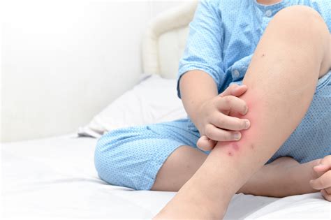 Bed Bug Bites Symptoms Treatment And Prevention Terminix