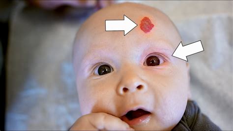 Adorable Baby With Pink Eye And Hemangioma Can Breastmilk Cure Pink Eye