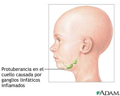 Medlineplus Enciclopedia M Dica Protuberancia En El Cuello