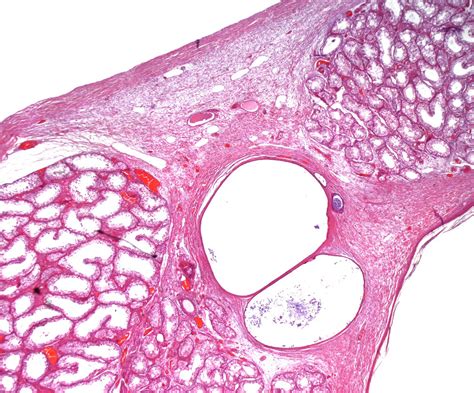 Intratesticular Epidermoid Cyst A Rare Tumor Aneiros Fernandez