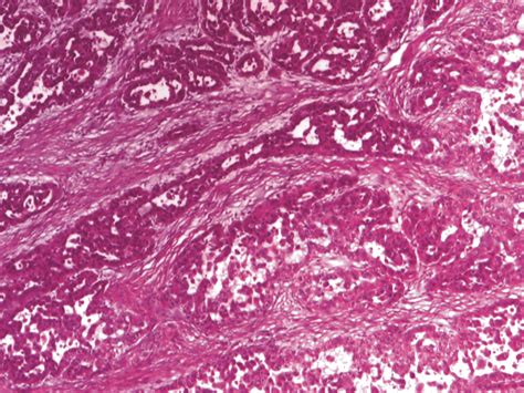 Acantholytic Squamous Cell Carcinoma With Many
