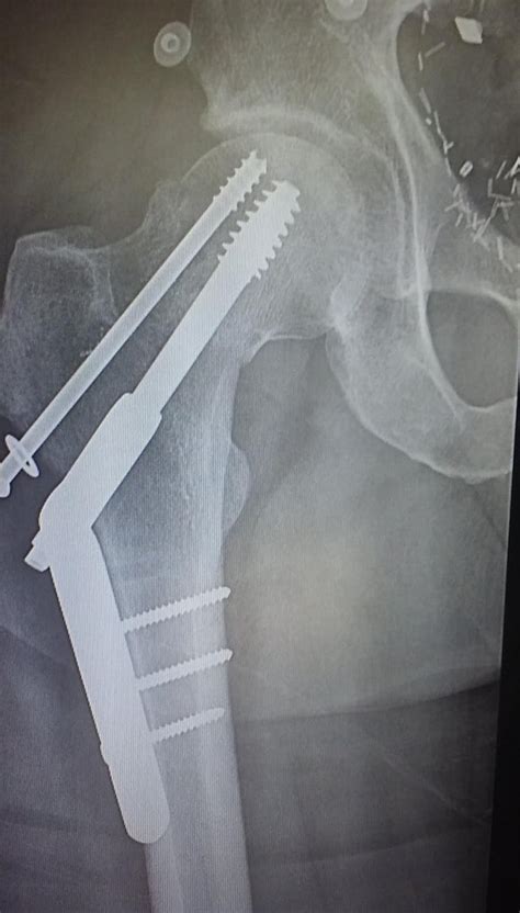 Hip Repair After 10 Weeks Radiology
