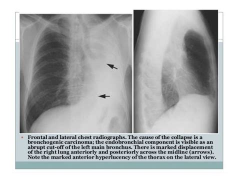 Collapse And Consolidation Lung Radiology