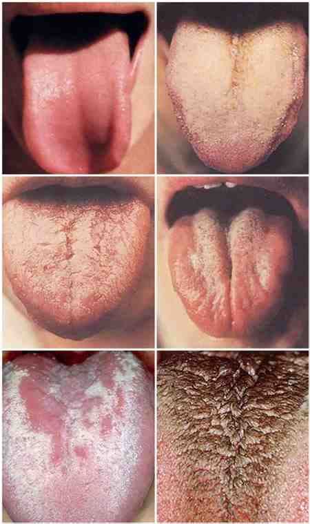 Tonsil Hypertrophy Throat Tongue Spots White Sore League