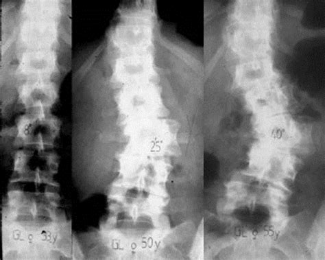 Adult Spinal Deformity Spine Orthobullets