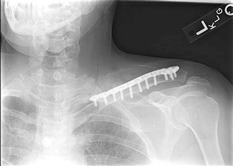 Clavicle Plating System Acumed