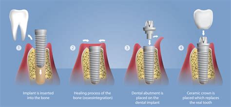 Dental Implants By Manassas Smiles Dental Clinic In Manassas Va
