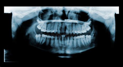 Panoramic Dental Tooth X Ray Of A Teenage Male Orthopantomography Opg