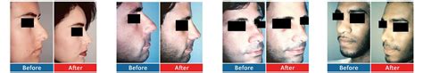Health insurance will not cover your nose job. Rhinoplasty cost $3,690. Nasal Surgery with Amazing Results