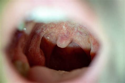 Inflamed Tonsils Stock Photos Pictures And Royalty Free Images Istock