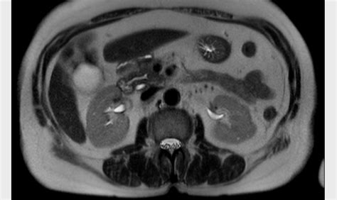 Pancreas Divisum Image