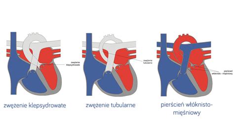 Nadzastawkowe zwężenie aorty