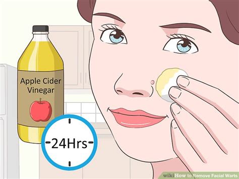 Doctor Approved Advice On How To Remove Facial Warts Wikihow