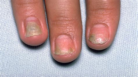 How Psoriatic Arthritis Can Damage Your Nails Everyday Health