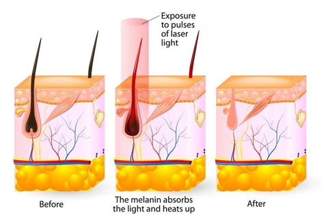 How Does Laser Hair Removal Work About Hair Removal Livsmooth