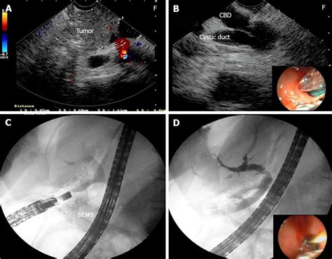 Different Options Of Endosonography Guided Biliary Drainage After