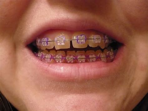 10 Good Reasons To Choose Purple Braces Braces Colors Dental Braces Brace Face