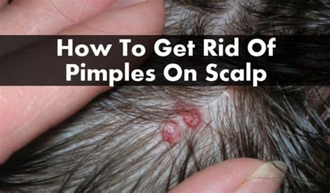 A Lot Of People Who Suffer From Scalp Acne But They Are A Bit Unsure