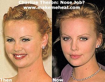 Charlize Theron Plastic Surgery Before And After Nose Job And Facelift