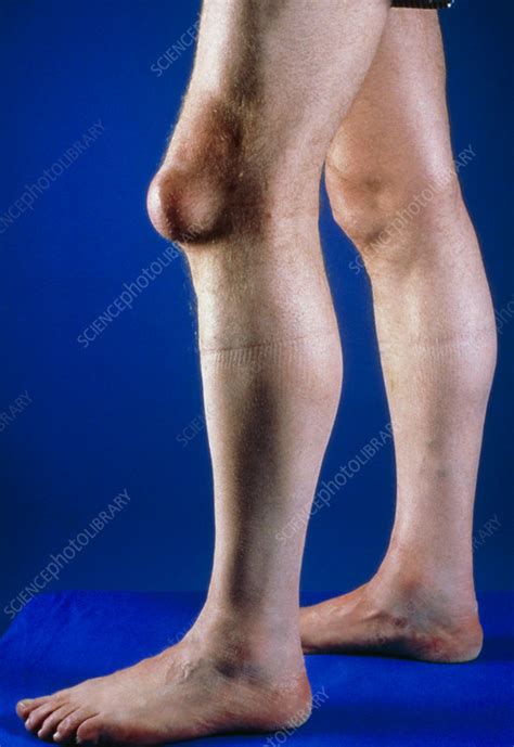 Pre Patellar Bursa Swelling On Knee Stock Image M1200018