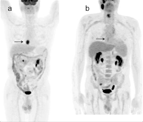A Maximum Intensity Projection Mip Image Of The 18 F Fdg Pet Ct