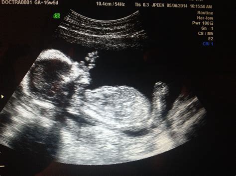 15 Weeks 5 Days Ultrasound Ultrasound Baby Boy