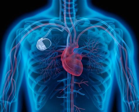 Uks First Artificial Heart Pump Due To Trial In 2018 Health Business