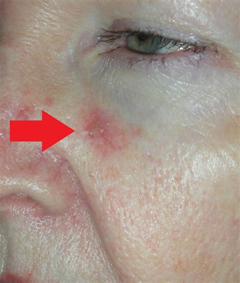 Skin Cancer Spot On Nose Forehead Reconstruction