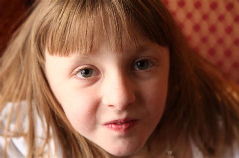 Photos Worldwide Research Of Turner S Syndrome