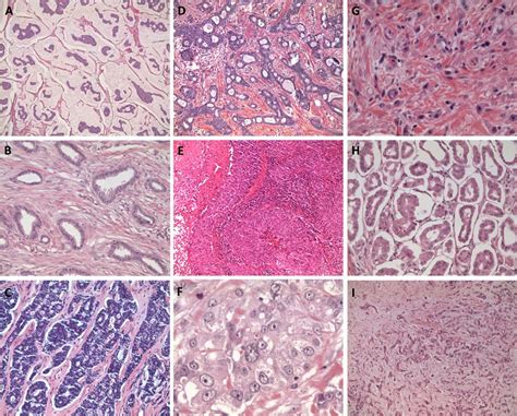 Rare Breast Cancer Subtypes Histological Molecular And Clinical
