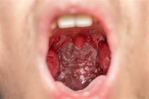 What Does Your Uvula Do Wonderopolis