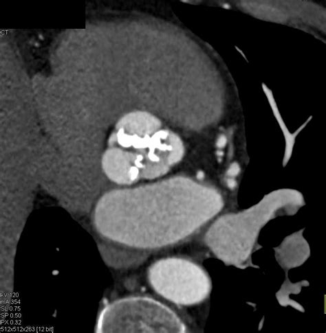 Aortic Stenosis With Extensive Aortic Valve Calcification Cardiac