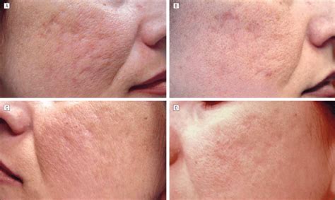 Acne Scarring Before Treatment A And C And After 4 Treatments B And