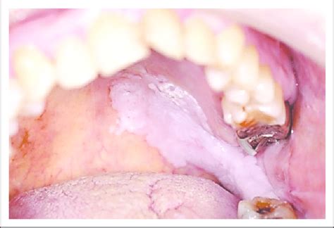White Patch Extending From Retromolar Area To The Hard Palate In A