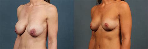 Breast Implants Remove And Replace