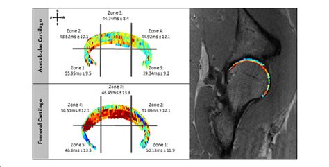 T2 Mapping Masks Of The Acetabular And Femoral Cartilage Geographic