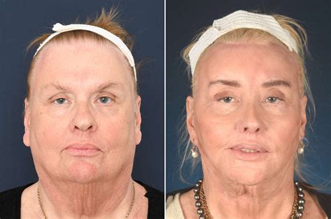 Facial Feminization Surgery Expertise In Europe Pass Clinic