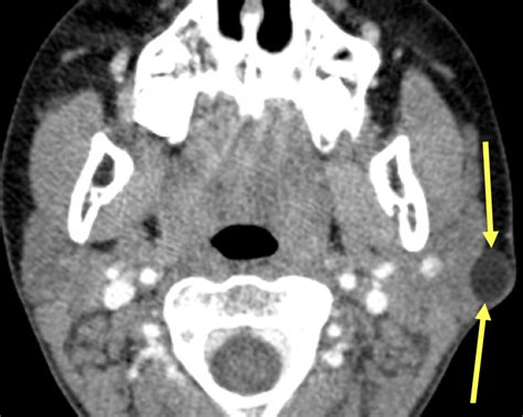 Dermoid Cyst Diagnosis Mri Online