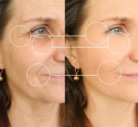 Woman Face Wrinkles Removal Before And After Therapy Tension Treatment