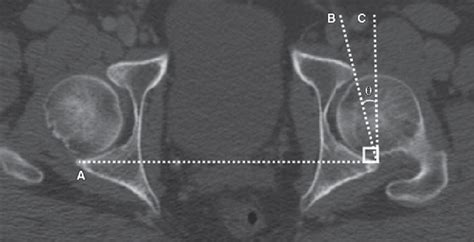Ct Scan Shows Angle Of Acetabular Version Line A Is Drawn Between Both