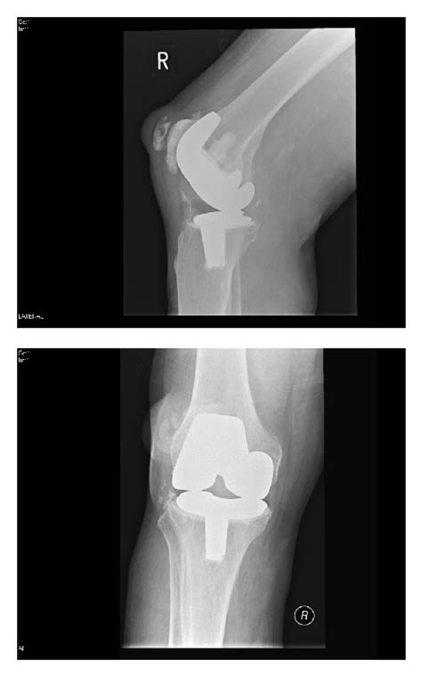 Postoperative Ap And Lateral Radiographs Of The Right Knee Showing That