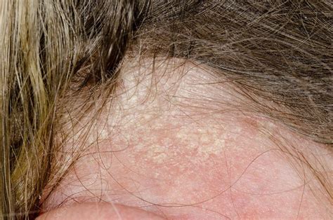 Psoriasis Of The Scalp Stock Image C013 0975 Science Photo Library