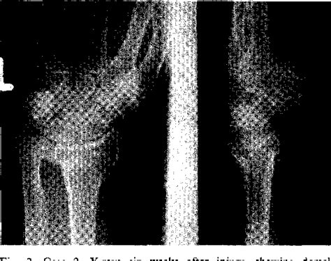 Figure 2 From Ulnar Nerve Palsy Following Fractures Of The Distal