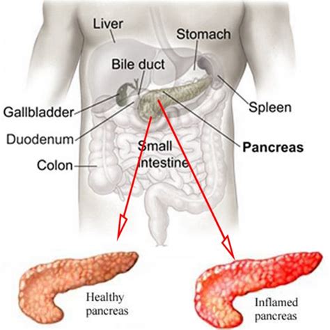 Types Of Acute Pancreatitis My XXX Hot Girl