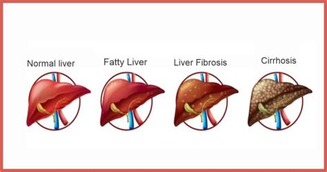 What Are The Final Stages Of Cirrhosis Of The Liver