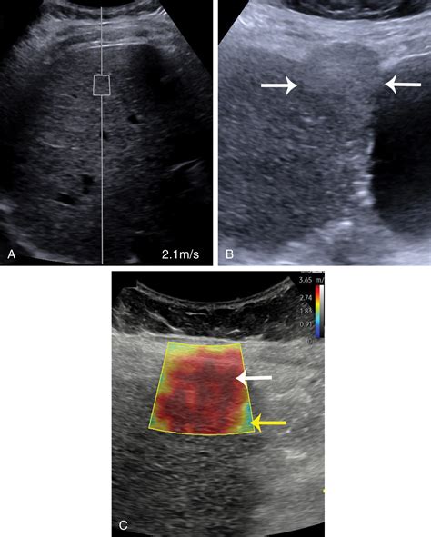 Focal Liver Lesions In The Setting Of Chronic Liver Disease Radiology Key