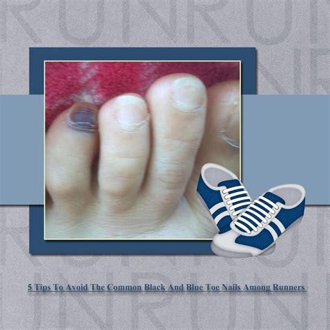 5 Tips To Avoid Black And Blue Toenails From Running I Heart Running