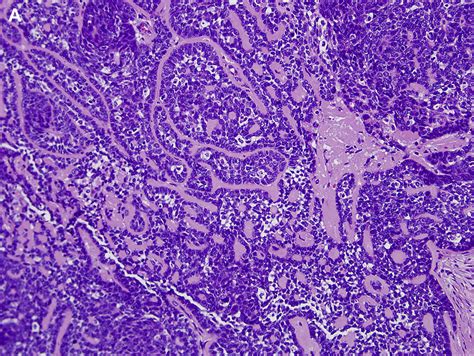 Squamous Cell Carcinoma Of The Oral Cavity And Oropharynx Surgical