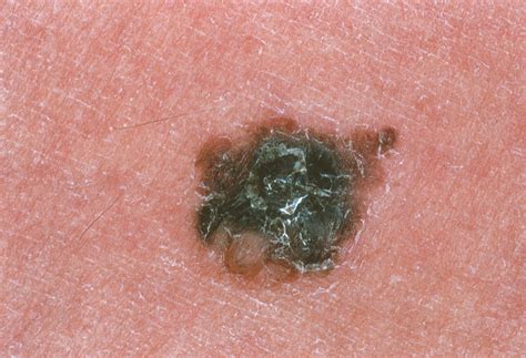 Skin Cancer Photograph By Cnriscience Photo Library Pixels